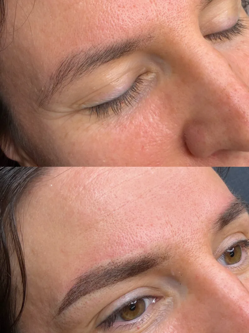 Before and after brow restoration
